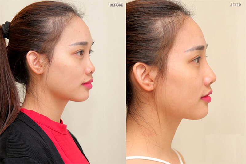 Hình ảnh trước và sau khi nâng mũi đẹp