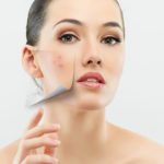 10 Cách điều trị hiệu quả tình trạng da khô khi bị mụn