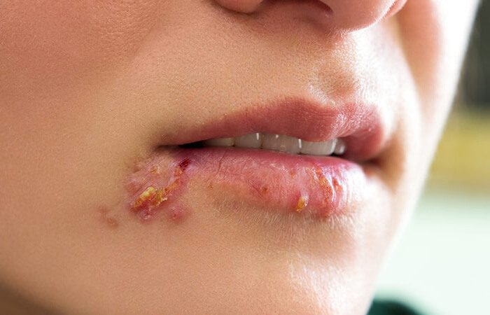 Dấu hiệu và triệu chứng của lở miệng và mụn nhọt