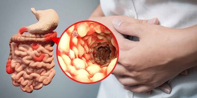 Bệnh Crohn: Nguyên nhân, triệu chứng và phương pháp điều trị