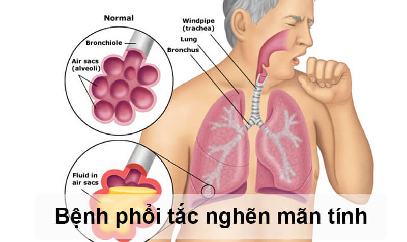 Bệnh phổi tắc nghẽn mãn tính (COPD): nguyên nhân và cách điều trị