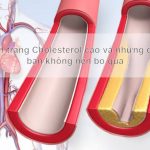 Tình trạng Cholesterol cao và những điều bạn không nên bỏ qua