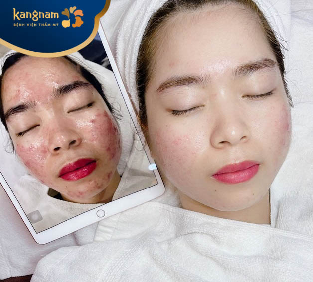Khách hàng Minh Trang (23 tuổi) sau điều trị mụn nang tại Kangnam