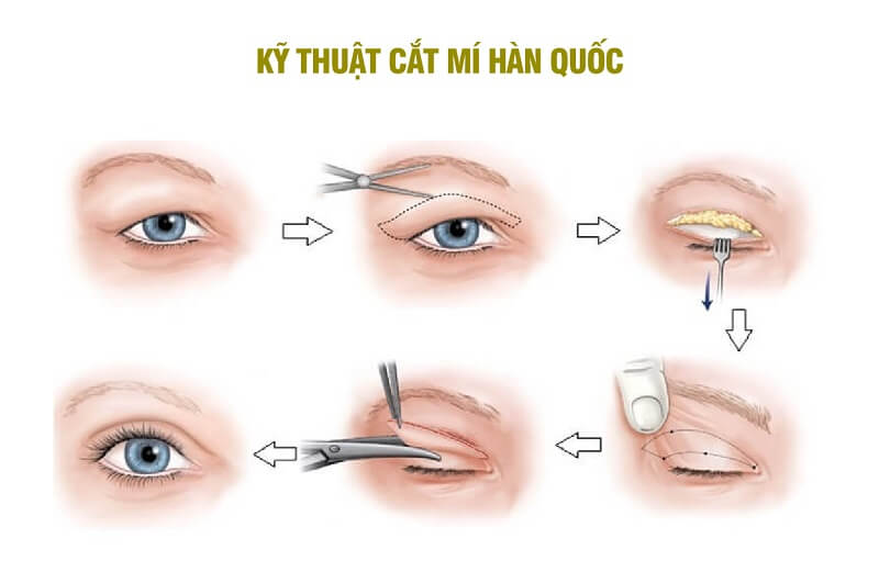 Mô phỏng kỹ thuật cắt mí mắt