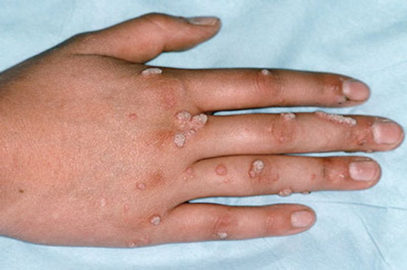 Mụn cơm hay mụn cóc là một bệnh lý về da do virus HPV gây ra. Virus này có khả năng làm tăng cao da tạo nên các nốt sần sùi nhỏ lành tính xuất hiện trên bề mặt da