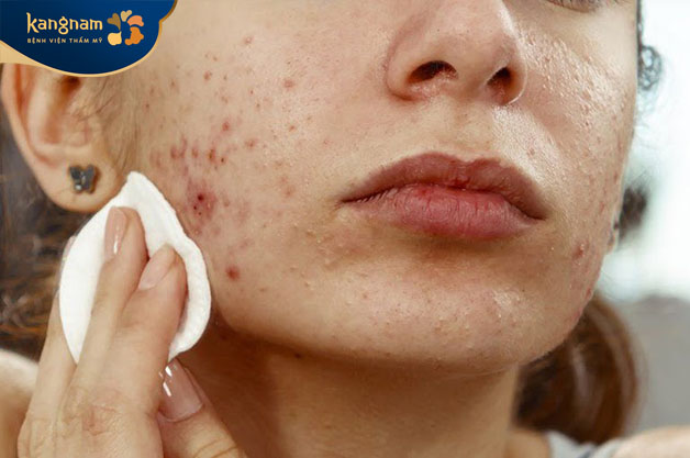 Hàng ngày không làm sạch da mặt đúng cách khiến bụi bẩn tích tụ gây mụn 