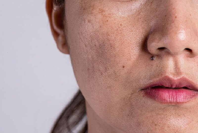 Phân biệt các loại nám da mặt vùng má đơn giản nhất