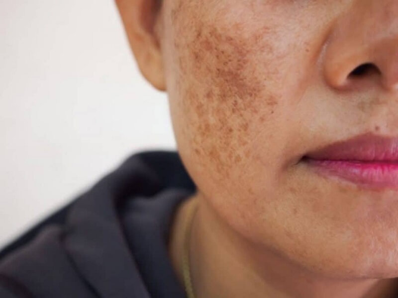 Nguyên nhân nào gây ra nám da mặt vùng má?