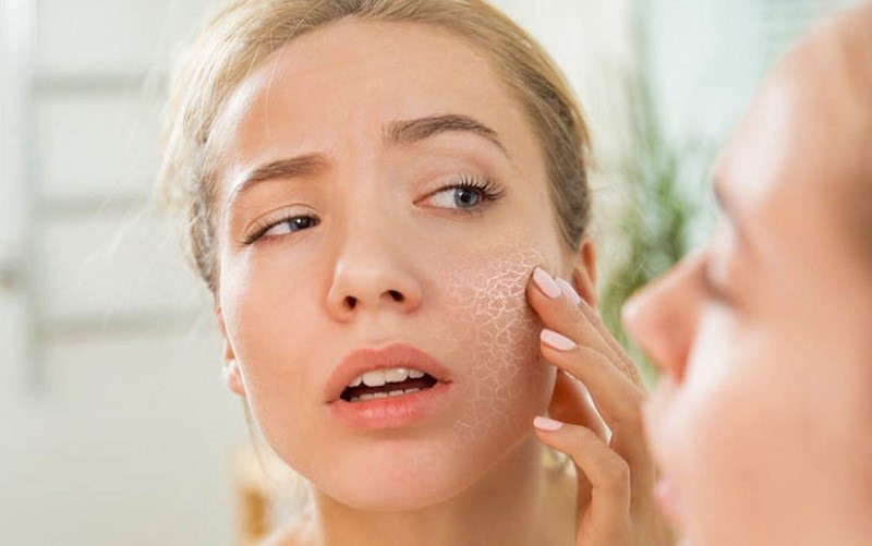 Da khô và da nhạy cảm có nên thực hiện đắp mặt nạ chanh không?