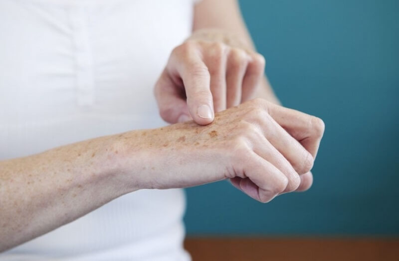 Bị nám da ở tay có phải là bệnh không?